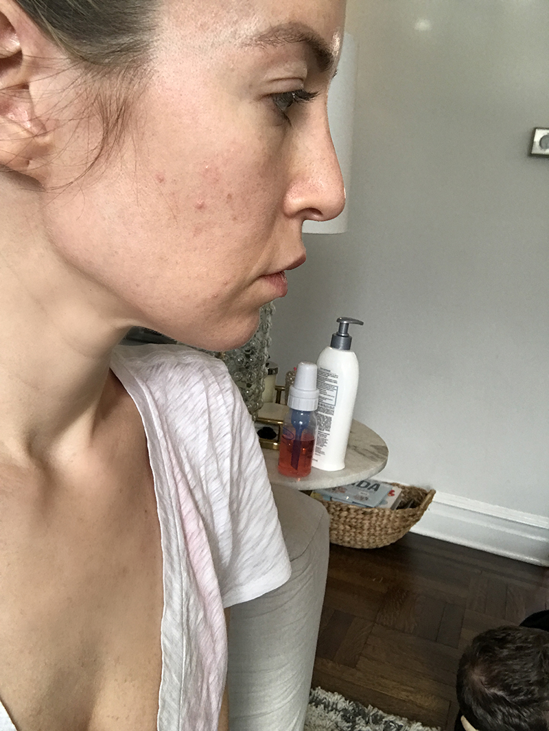 woman showing her acne after her baby and before the fraxel laser treatment