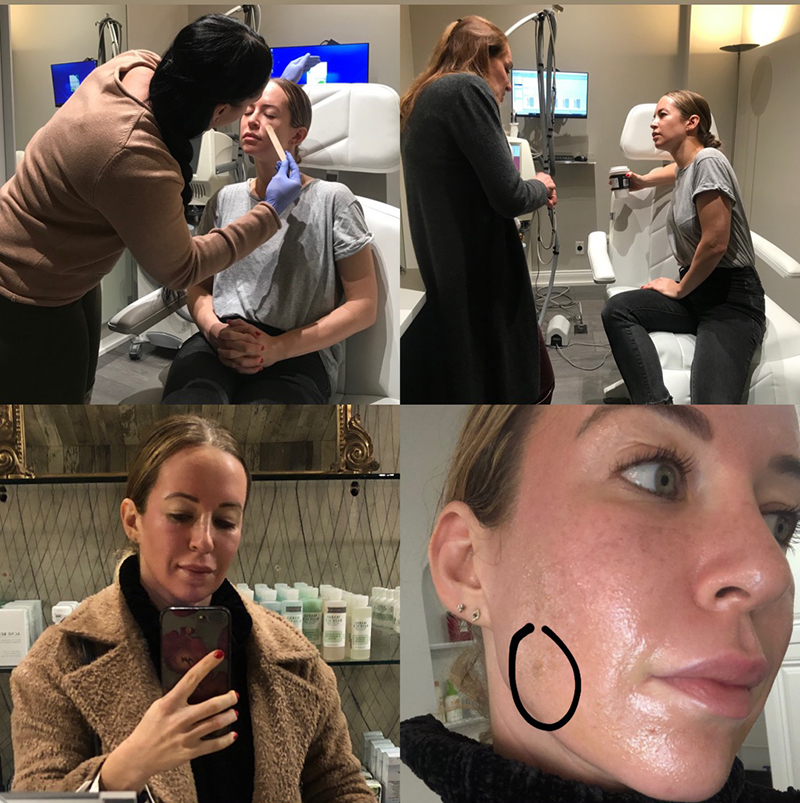 collage of images of fraxel laser treatment experience diary and progress of a woman