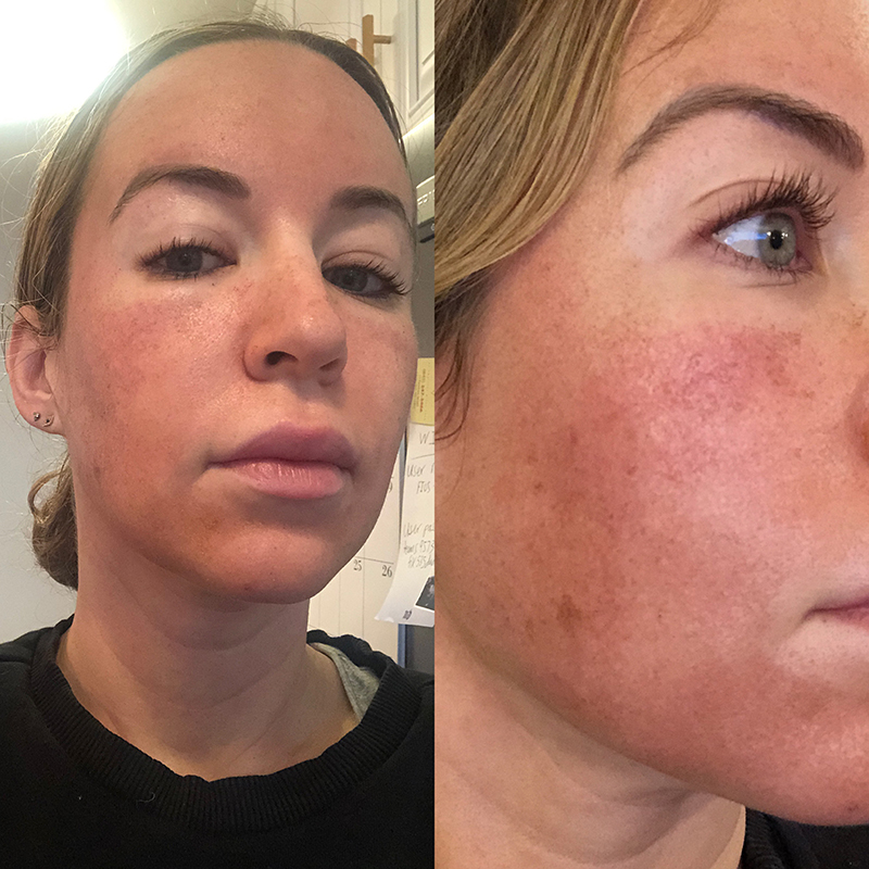 closeup image recovery process of a woman's face after fraxel laser treatment