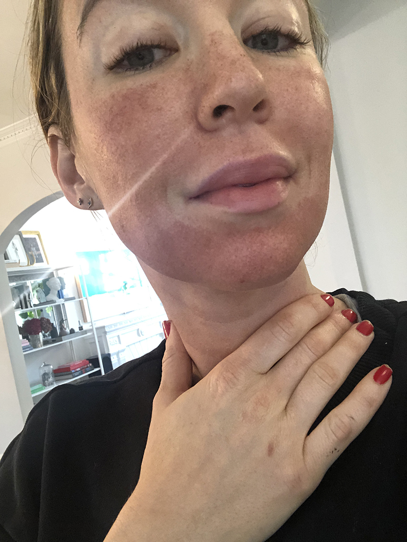 woman's face after fraxel laser treatment