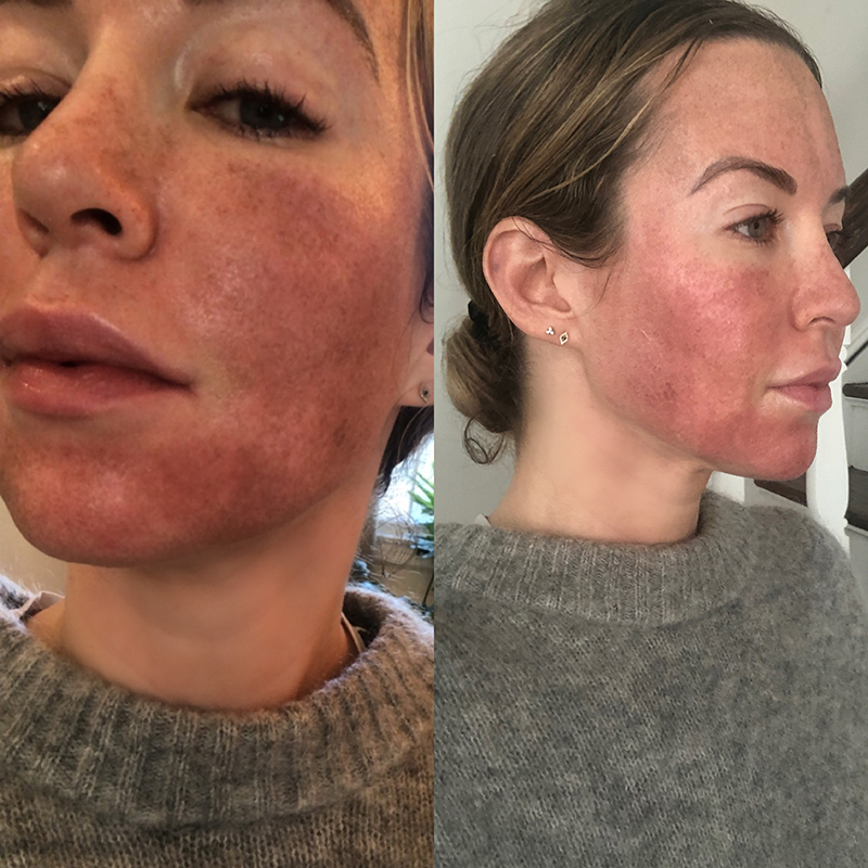 two images of the face of a woman after fraxel laser treatment experience