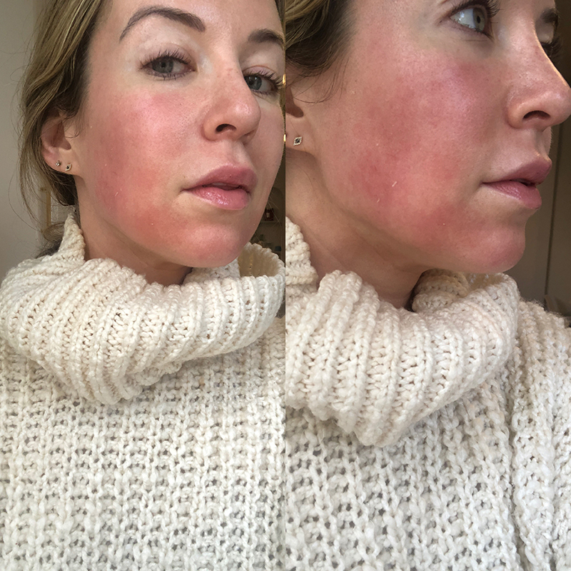woman's face clearing up after fraxel laser results