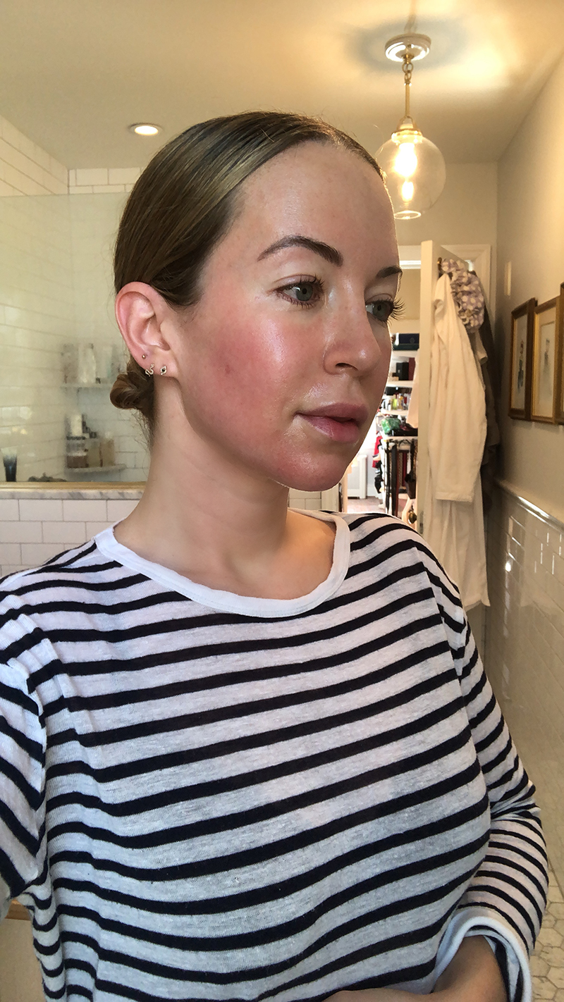 the face of a woman clearing up after skin treatment experience